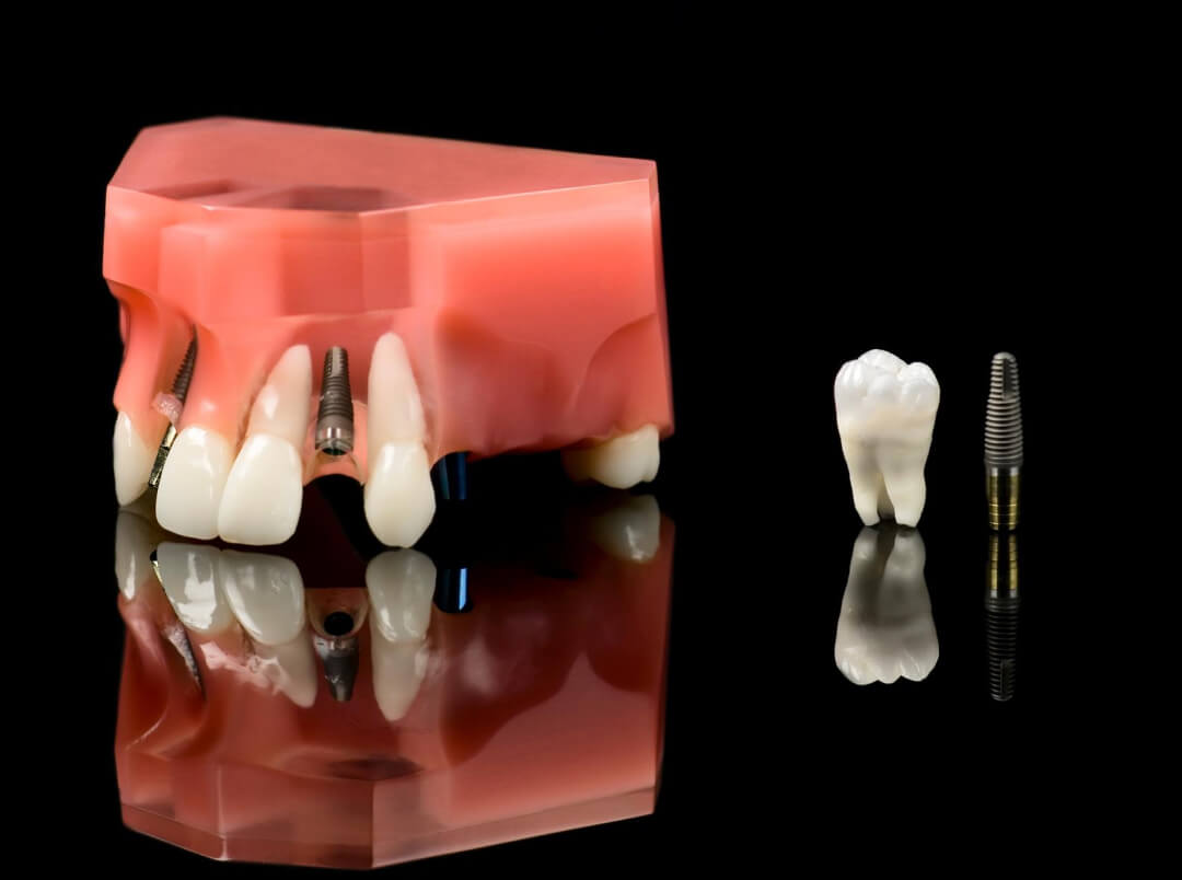 ⾍⻭治療×インプラント